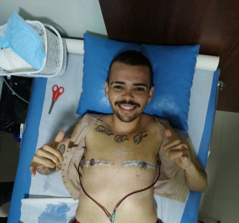 Carlos Vitor dos Santos,  homem transgênero após fazer fazer a mastectomia masculinizadora. Foto: Arquivo Pessoal